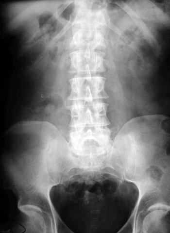 Radiografía simple de abdomen: Sólo para 4 cosas