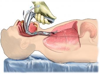 intubacion endotraqueal en urgencias